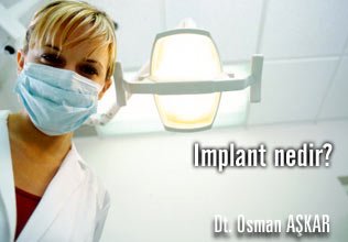 Implant hakkında merak ettikleriniz