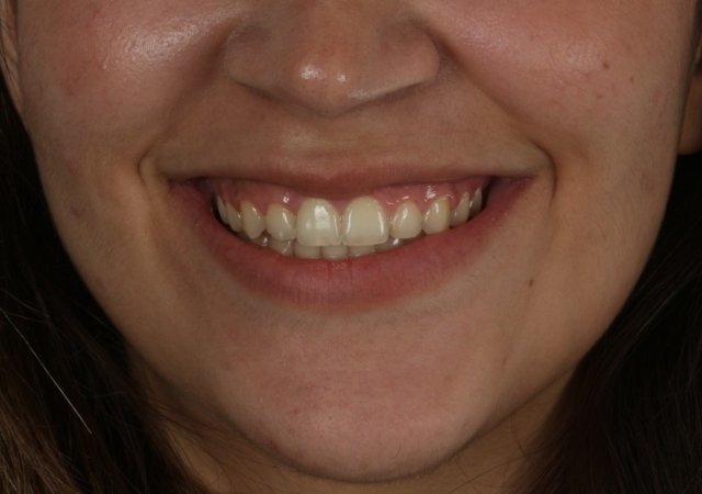 Ortodonti tedavisinden sonra dişlerin sallanması normal midir?