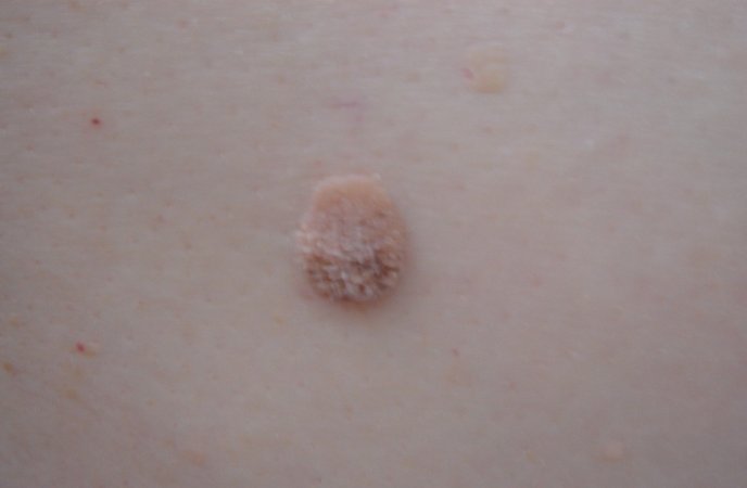 Human papilloma virüs yani hpv nedir? hpv aşıları ile ilgili bilgiler