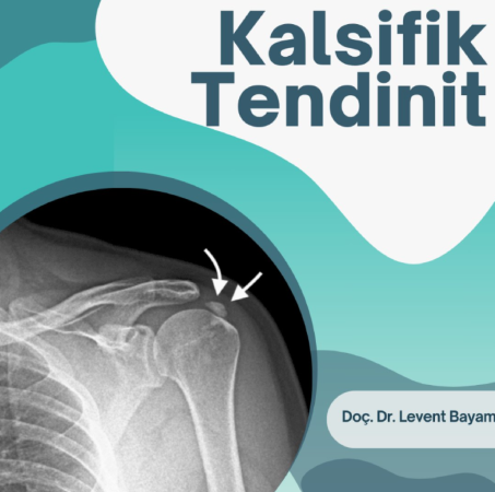 Kalsifik tendinit