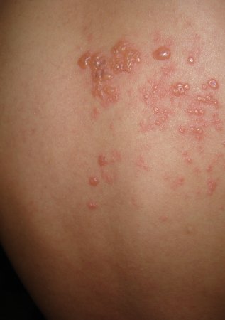Herpes zoster, zona veya halk dilinde gece yanığı
