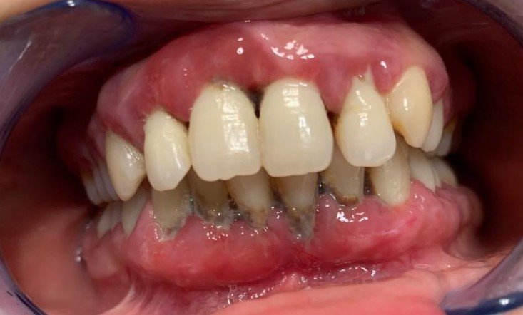 Dişeti hastalığı- periodontitis