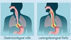 Gastroözefageal reflu-larengofarengeal reflü hastalığı- mide asidinin boğaza ve ağıza gelmesi-mide asidi regürjitasyonu