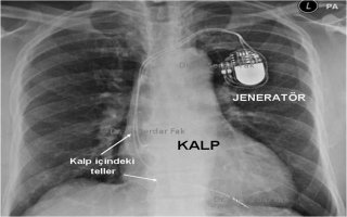 Kalp pilleri hakkında 1, kalp pili hastalarına öneriler