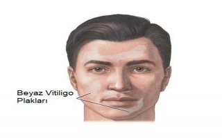 Vitiligo ( ala hastalığı )