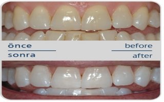 Diş beyazlatma ( bleaching ) nedir ?