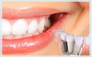 Diş eksikliği ve implant tedavisi
