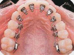 Estetik diş hekimliğinde gelişen lingual teknik…