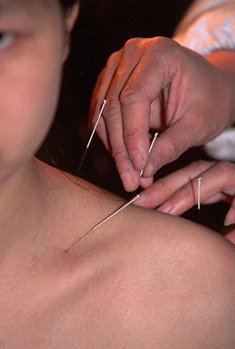 Akupunktur ile allerjik nezle (rinit) ve astım tedavisi