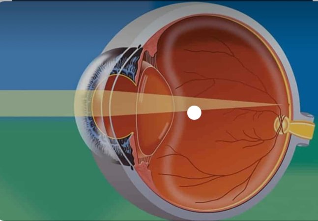 Retina neresidir?