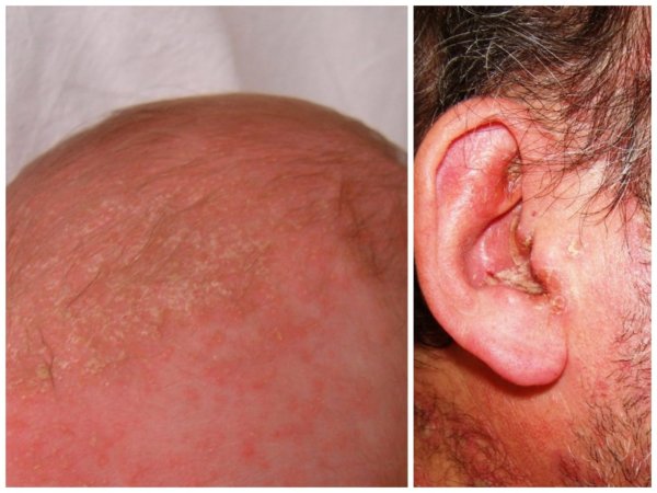 Seboreik dermatit yani yağlı ekzama, konak