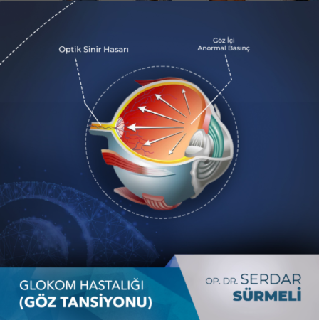 Glokom hastalığı (göz tansiyonu)