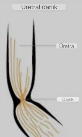 Erkeklerde idrar yolu (üretra) darlığı