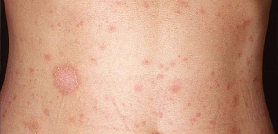 Pityriasis rosea: a natural history of pediatric cases in the central anatolia region of turkey