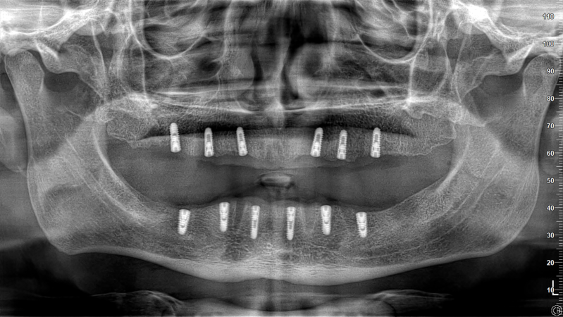 Dental implant