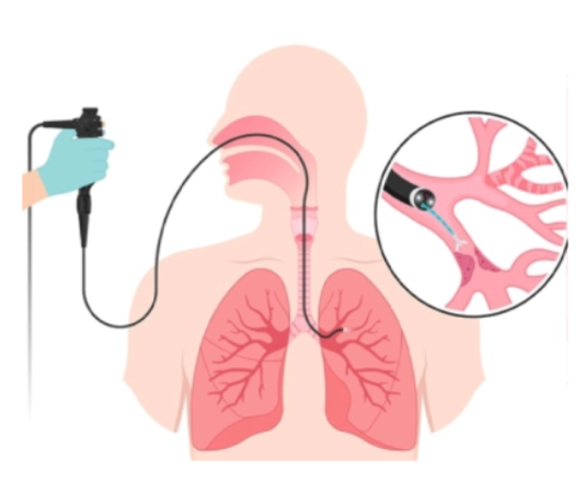 Endobronşiyal ultrason (ebus): akciğerlerin gizemli dünyasına yolculuk