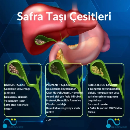 Safra kesesi taşı : tanı ve tedavi yöntemleri