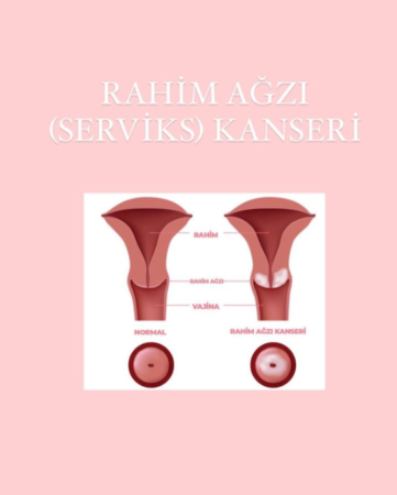 Rahim ağzı kanserinin ilk belirtileri nelerdir?