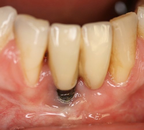İmplant sonrası ağız hijyeni ve peri-implantitis