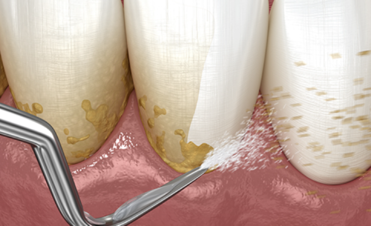 Diş taşı temizliği zararlı mıdır?