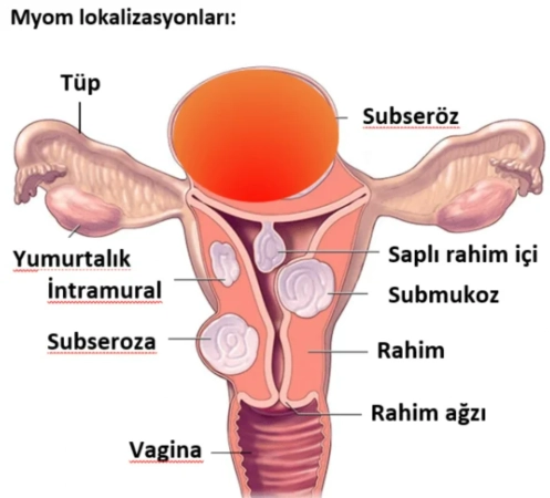 Endometrial polip tedavisi