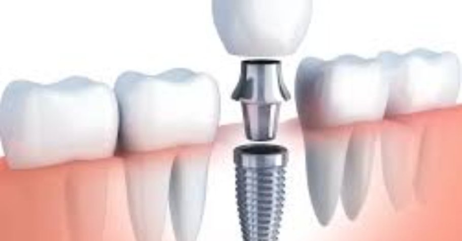 Dental implant Online Randevu