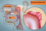 Geniz eti (adenoid vejetasyon)