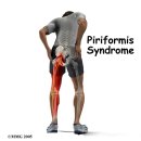 Piriformis sendromu