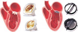 Mitral kapak ameliyatı