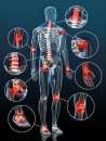 Osteoartrit ( kireçlenme )
