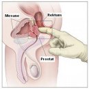 Bph nedir? bph ile ilişkili şikayetler nelerdir?