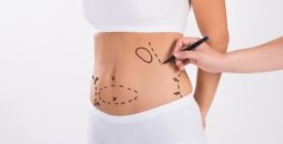 Karın germe veya abdominoplasti