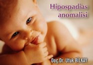 Hipospadias anomalisi