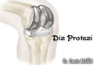 Diz protezi,