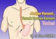 Akciğer kanseri, yemek borusu kanseri , tedavi