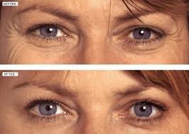Botox  uygulamaları