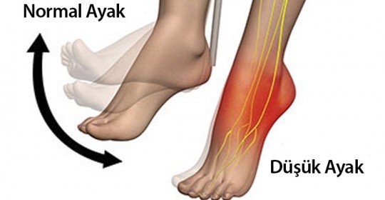 Düşük ayak