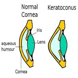 Keratokonus nedir?