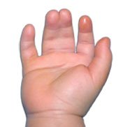 Yapışık parmak sendromu (sindaktili)