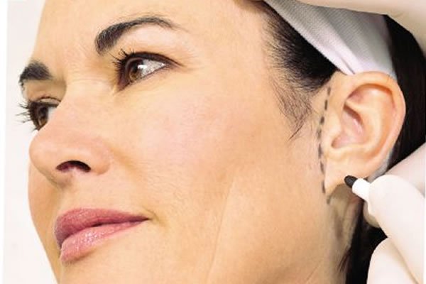 Kepçe kulak estetiği (ameliyatsız iple kulak estetiği – otoplasti)