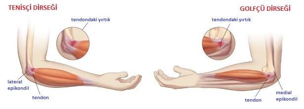 Dirsek; tenisçi ve golfçu dirseği