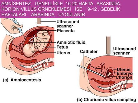 Amniyosentez nedir? gebeliğin kaçıncı haftası yapılır?