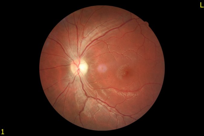Kalıtımsal optik sinir hastalıkları ve sebepleri