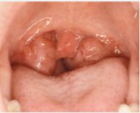 Tonsil