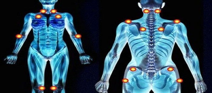 Fibromiyalji (fms) tanısı nasıl konulur?