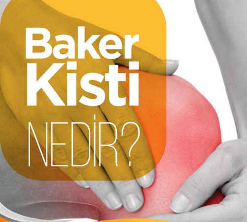 Baker kisti nedir ?