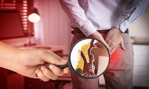 Hemoroidal hastalık hakkında