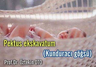 Pektus ekskavatum (kunduracı göğsü)