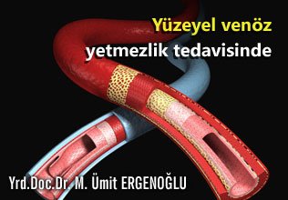 Kılcal damarların tedavisi: skleroterapi