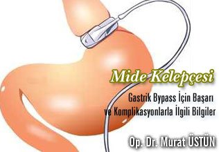 Mide kelepçesi ve gastrik bypass için başarı ve komplikasyonlarla ilgili bilgiler